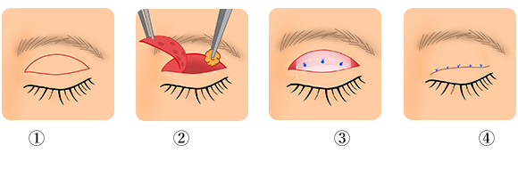 眼瞼下垂症の手術方法